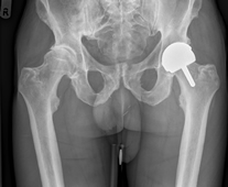 X-ray showing a Left Birmingham™ Resurfacing Hip Replacement.