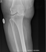 Severe Osteoarthritis of the knee