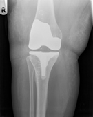 Same knee, after total knee replacement surgery. Note correction of deformity