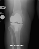  x-ray of a failing total knee replacement