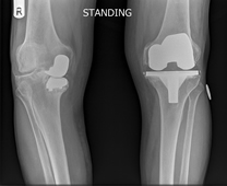 x-ray of failing medial uni-compartmental knee and failing total knee replacement