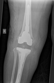 x-ray of same knee above,  now revised to a Legion ™ Revision knee replacement