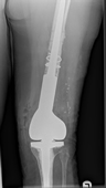 Endoprosthetic replacement of knee joint used for failed trauma surgery.
