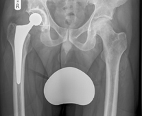 X-Ray of reverse hybrid hip replacement, with a cemented highly cross linked polyethylene cup (Reflection™) and an uncemented femoral stem (Polar stem™)