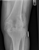 X-ray of knee, showing severe osteoarthritis of the joint, with bone loss, and subluxation of the joint.