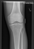 X-ray of a normal knee